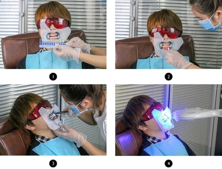 teeth whitening kit