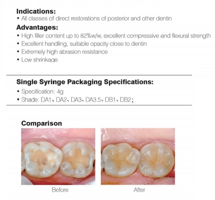 light curable composite posterior