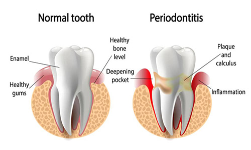 periodontitis 1