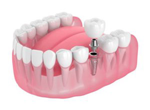 dental implant1