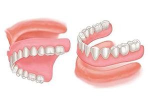 removable denture1